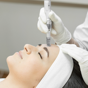 Microneedling